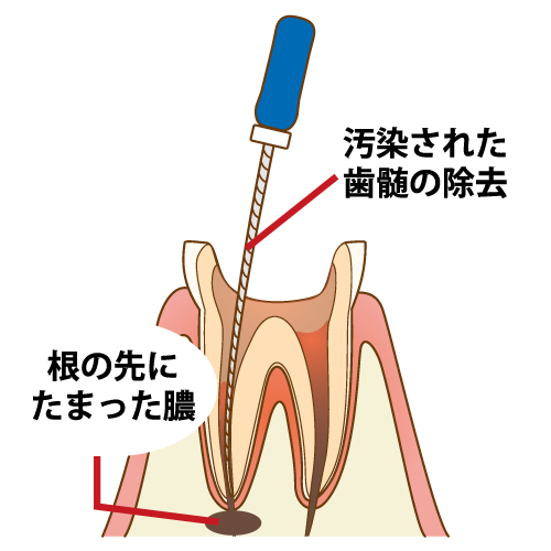 根管治療とは